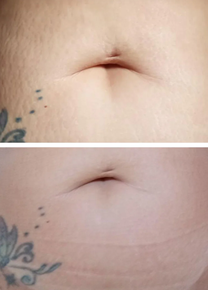 Antes e Depois Estrias 4